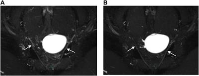 3D MR neurography with gadolinium contrast to improve the visualization of pelvic nerves and the branches